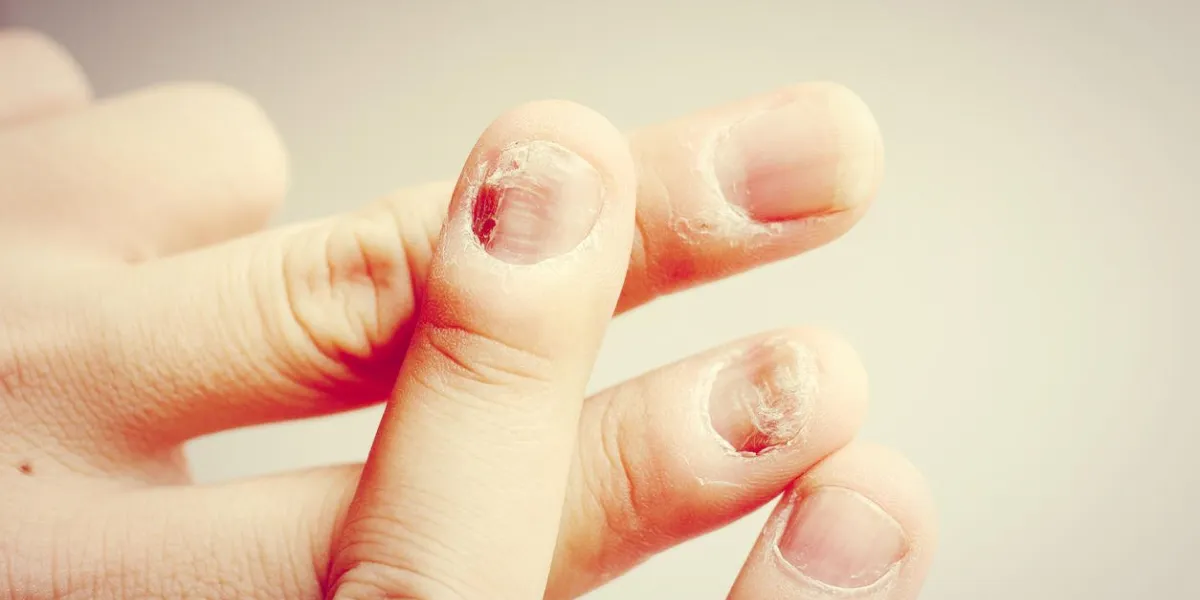 infection fongique sur la main des ongles, doigt avec onychomycose - infection du foyer foyer mou sur la main des ongles, doigt avec onychomycose - flou