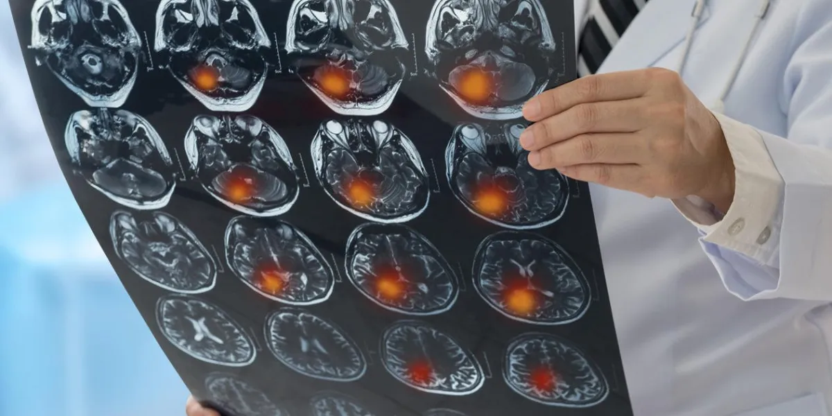 brain tumor or stroke cerebrovascular doctor examines the mri scan brain x-ray image of the patient