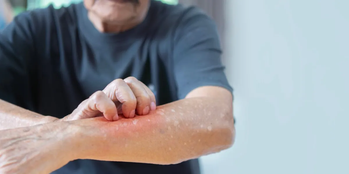 cropped image of asian elder man scratching his forearm concept of itchy skin diseases such as scabies, fungal infection selective focus, copy space