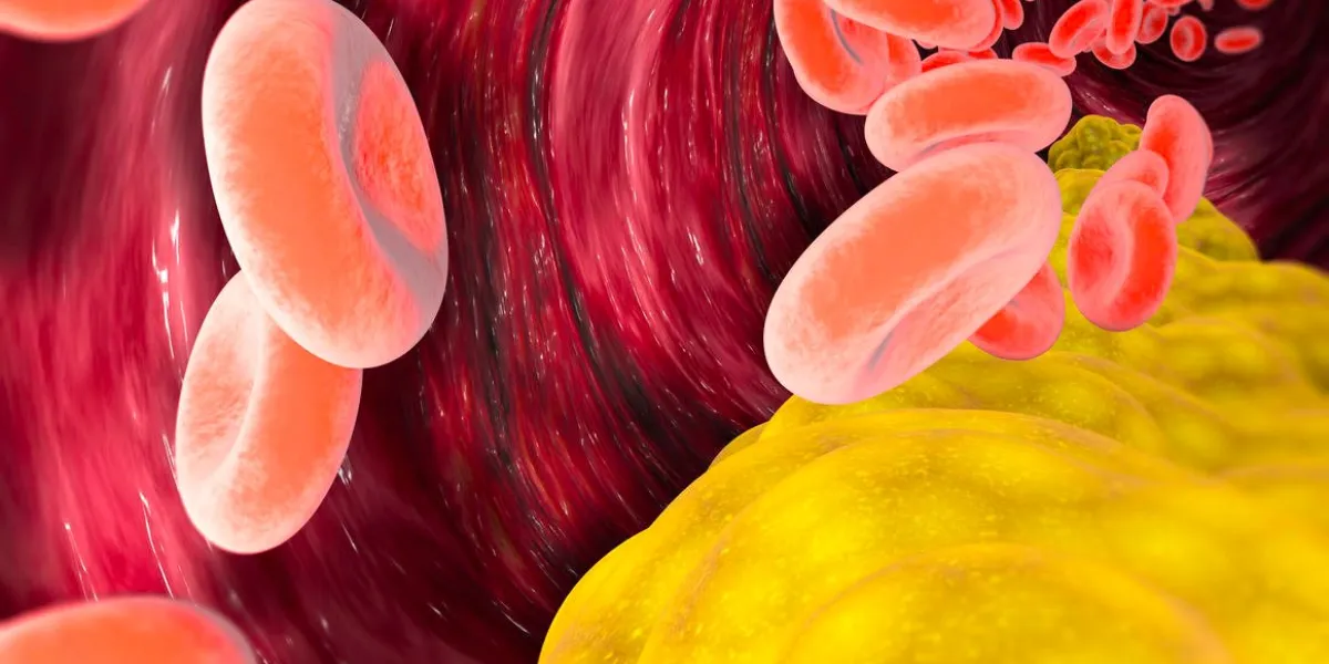 cholesterol formation, fat, artery, vein, heart narrowing of a vein for fat formation