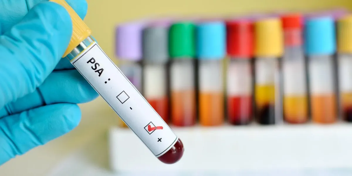 échantillon de sang avec psa (antigène prostatique spécifique) positif
