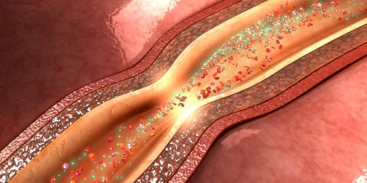 circulation coronarienne est la circulation du sang dans les vaisseaux sanguins du myocarde du muscle cardiaque connu sous le nom d'artères coronaires