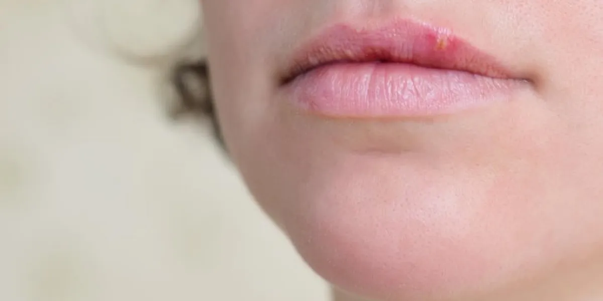 gros plan des lèvres féminines souffrant d'herpès