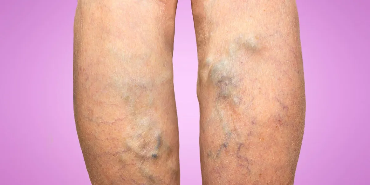 the varicose veins on a legs of old woman isolated on pink
