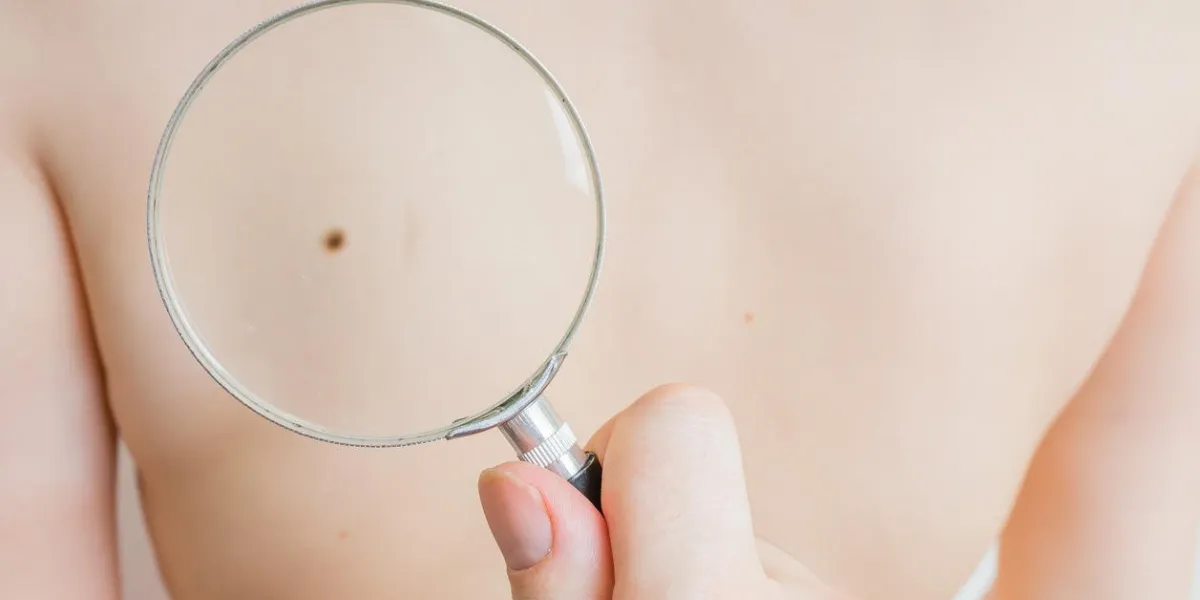 médecin tient la loupe à la main et examine la peau du patient pour suspicion de mélanome