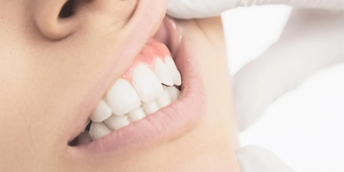 les dents blanches visitent les gencives rougeâtres