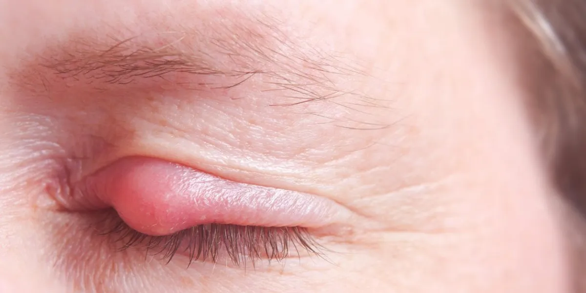 gros plan d'une paupière sérieusement infectée avec sty