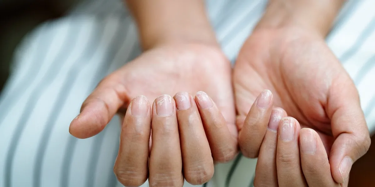 brittle damaged nails after using shellac or gel-lacquer