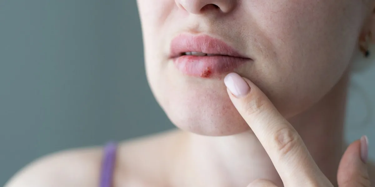 the woman with a virus herpes on lips
