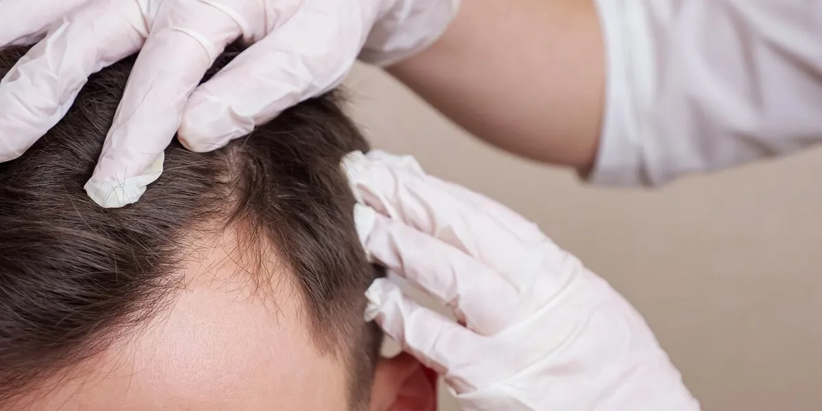 medical worker in gloves examines the head of a balding man close-up