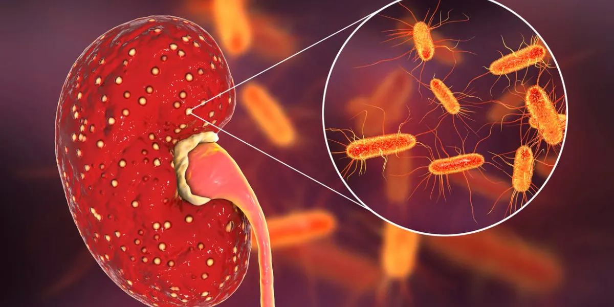 acute pyelonephritis, medical concept, and close-up view of bacteria escherichia coli, the common causative agent of kidney infection, 3d illustration
