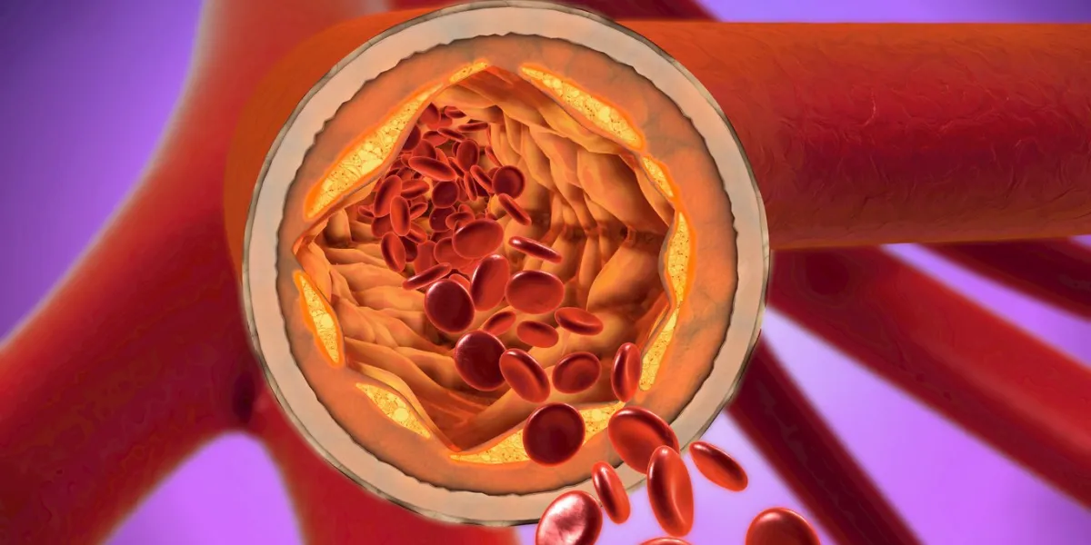 3d illustration of a precipitated and narrowing blood vessels or arteriosclerosis