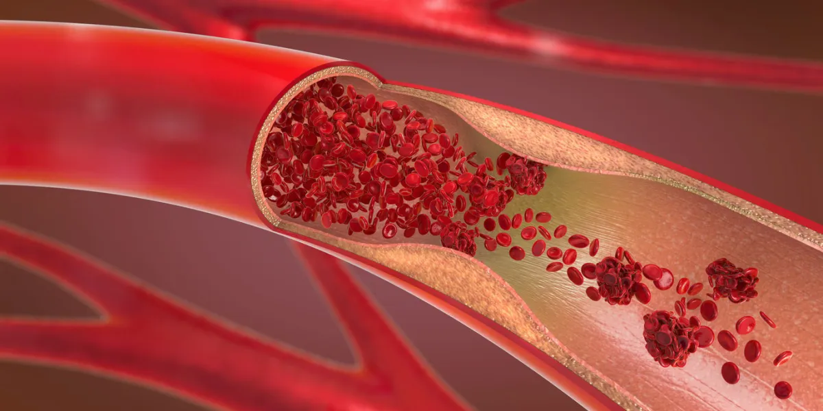 3d illustration of a constricted and narrowed artery and the blood cannot flow properly called arteriosclerosis