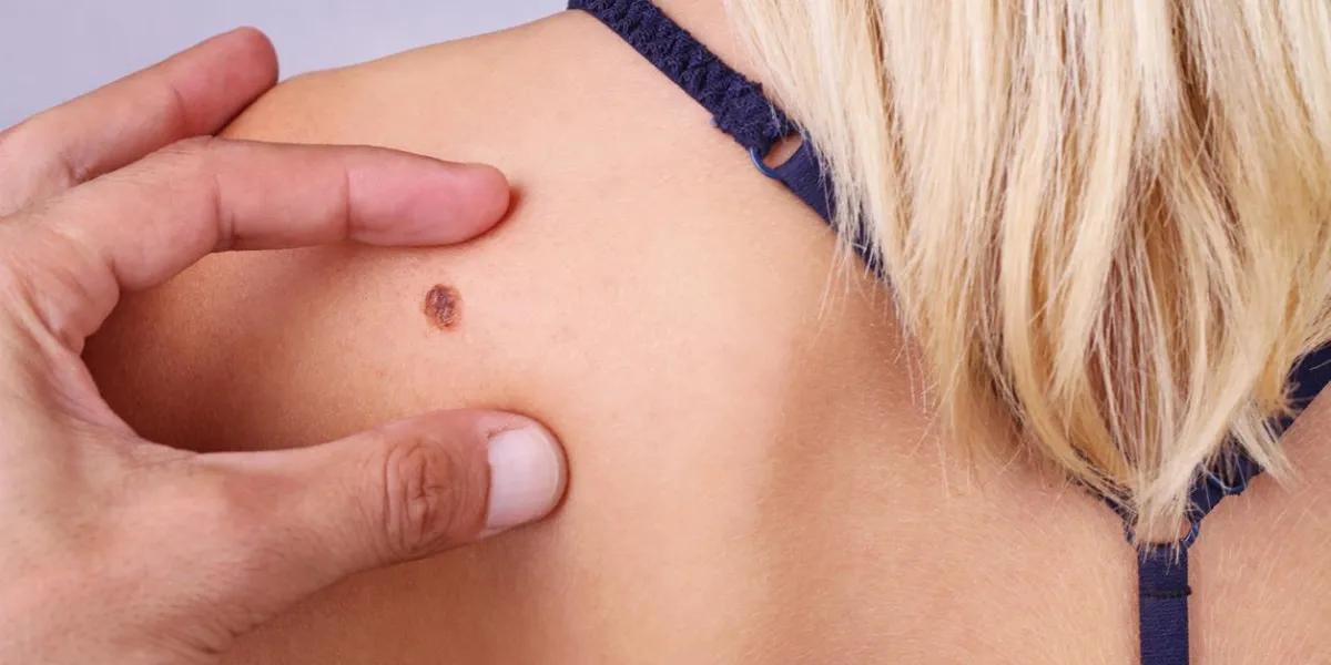 médecin, dermatologue, mains examine une marque de naissance du patient en vérifiant les taupes bénignes