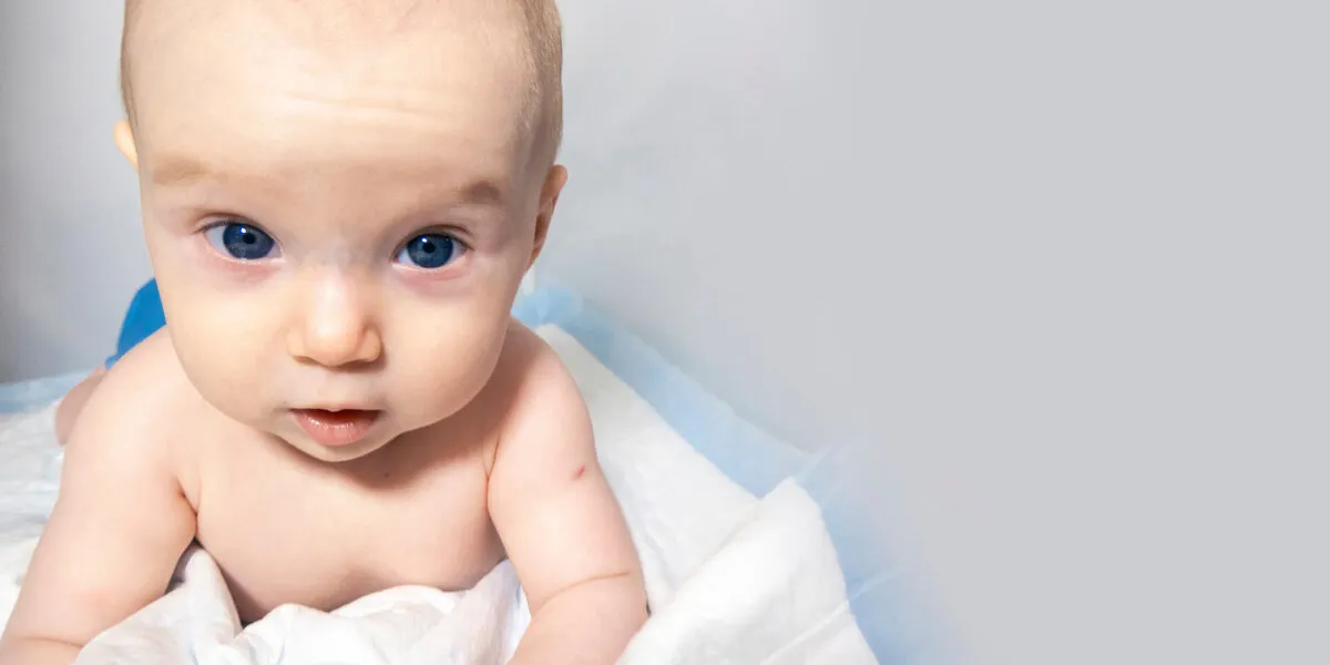 a baby with a hemangioma on his neck lies on a white background banner with a copy space face of a little bald baby girl the kid looks from under his brows