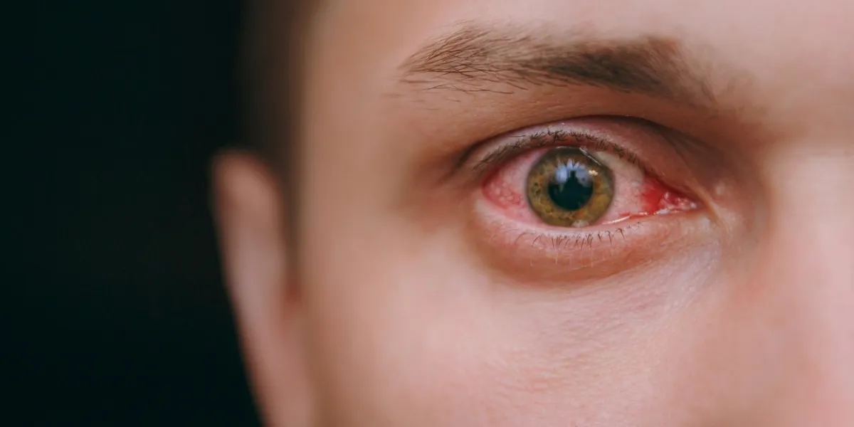 the close up of one annoyed red blood eye of a man affected by conjunctivitis