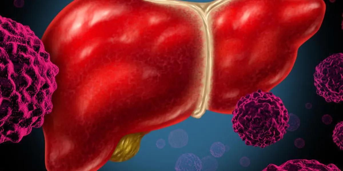 organe du cancer du foie humain comme un symbole médical d'une tumeur maligne maladie des globules rouges comme une croissance cancéreuse se propageant à travers le système digestif par l'alcool et d'autres raisons toxiques pour l'environnement