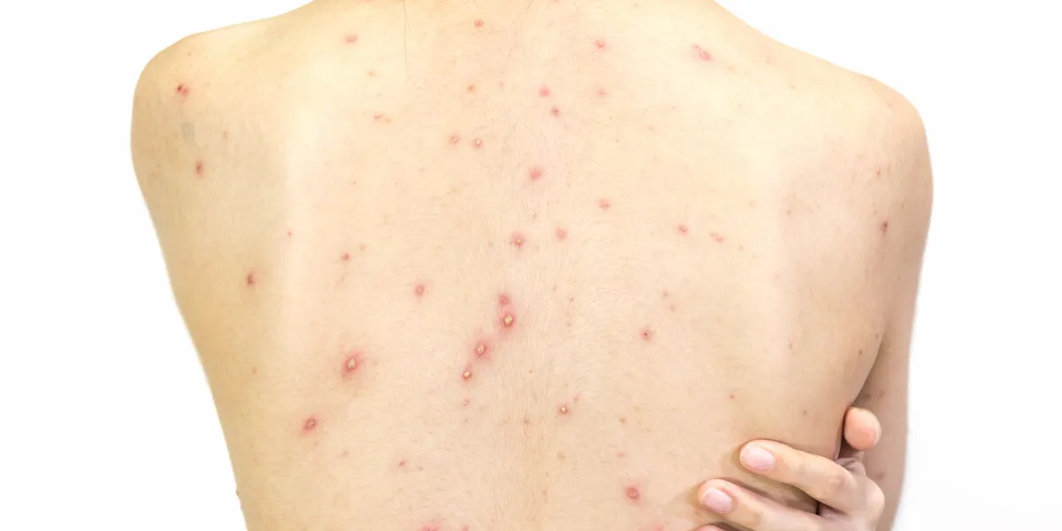 closeup of girl back of blisters, scar and rash caused by varicella virus or chicken pox on white background