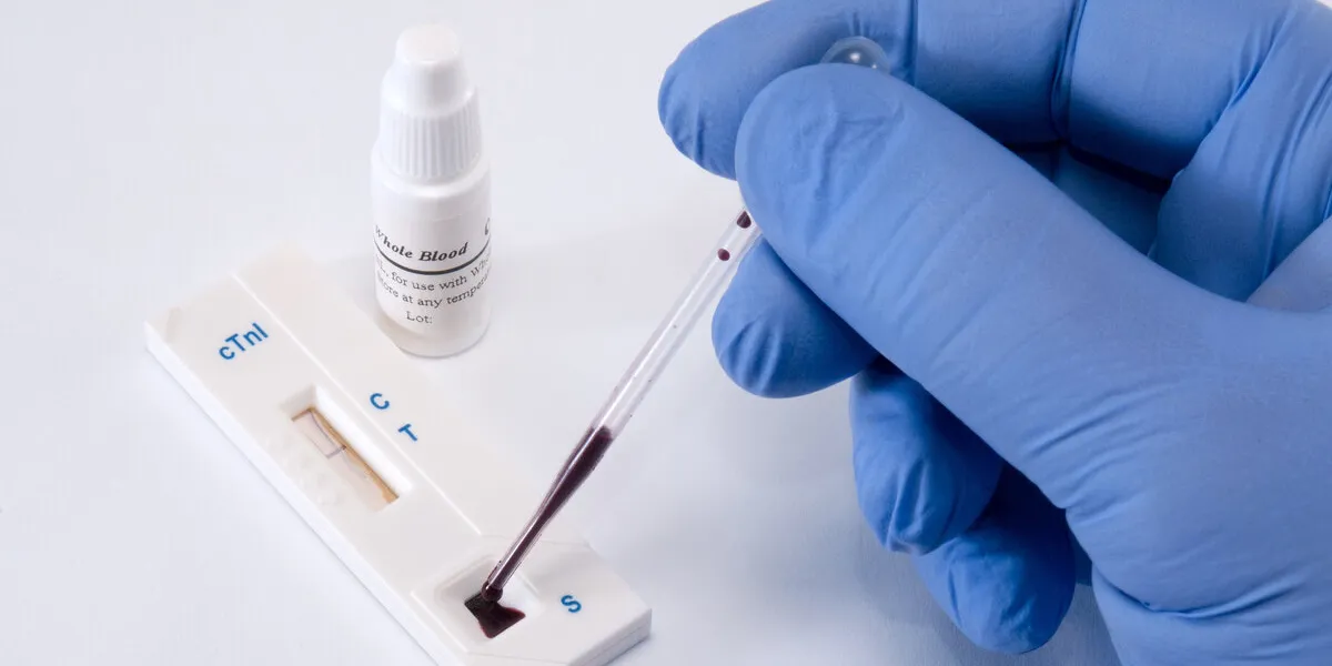 test, troponin, on heart attack of the myocardium for diagnostics in laboratory