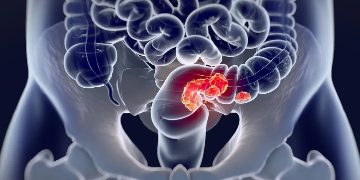 cancer colorectal, illustration anatomique médicale illustration 3d cancer colorectal, illustration anatomique médicale illustration 3d