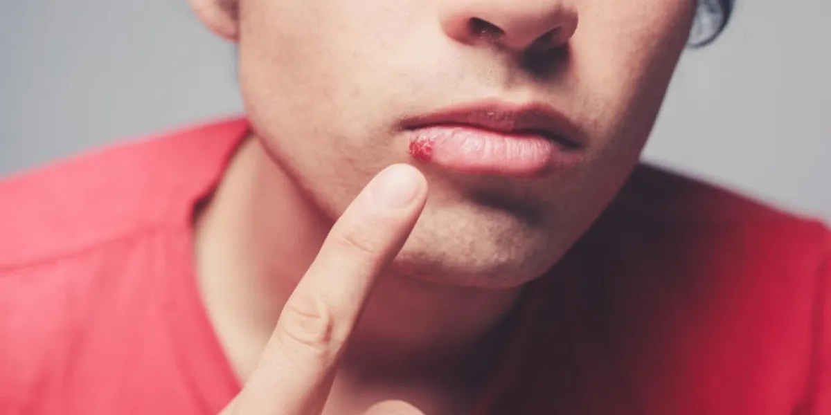 jeune homme montre une plaie de froid sur sa lèvre