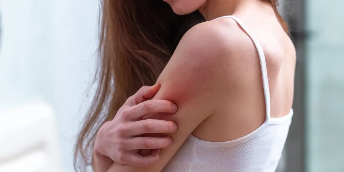 young woman suffering from itching on her skin and scratching an itchy place allergic reaction to insect bites, dermatitis, food, drugs health care concept allergy rash