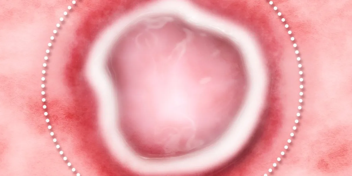 aphthous stomatitis is a common condition characterized by the repeated formation of benign and non-contagious mouth ulcers canker sores