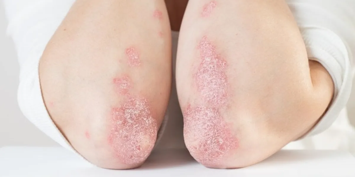acute psoriasis on the elbows is an autoimmune incurable dermatological skin disease large red, inflamed, flaky rash on the knees joints affected by psoriatic arthritis