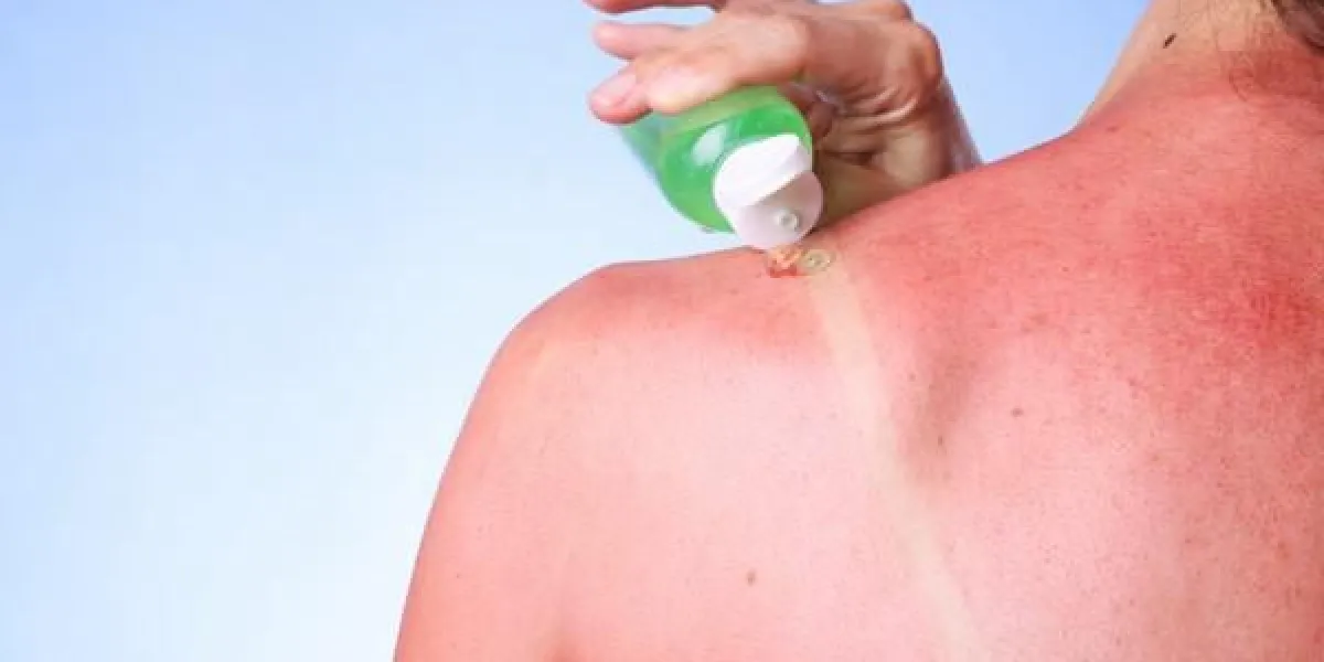 femme, appliquer, gel aloe vera, sur, elle, sunburned, épaule