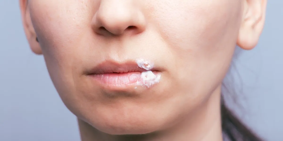 macro shot of herpes virus on mouth of young woman herpes smeared with curative ointment