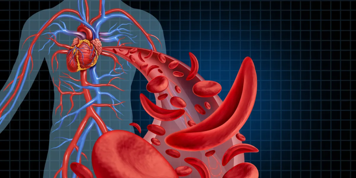 sickle cell cardiovascular heart blood circulation and anemia as a disease with normal and abnormal hemoglobin in a human artery anatomy as a medical illustration concept with 3d illustration elements