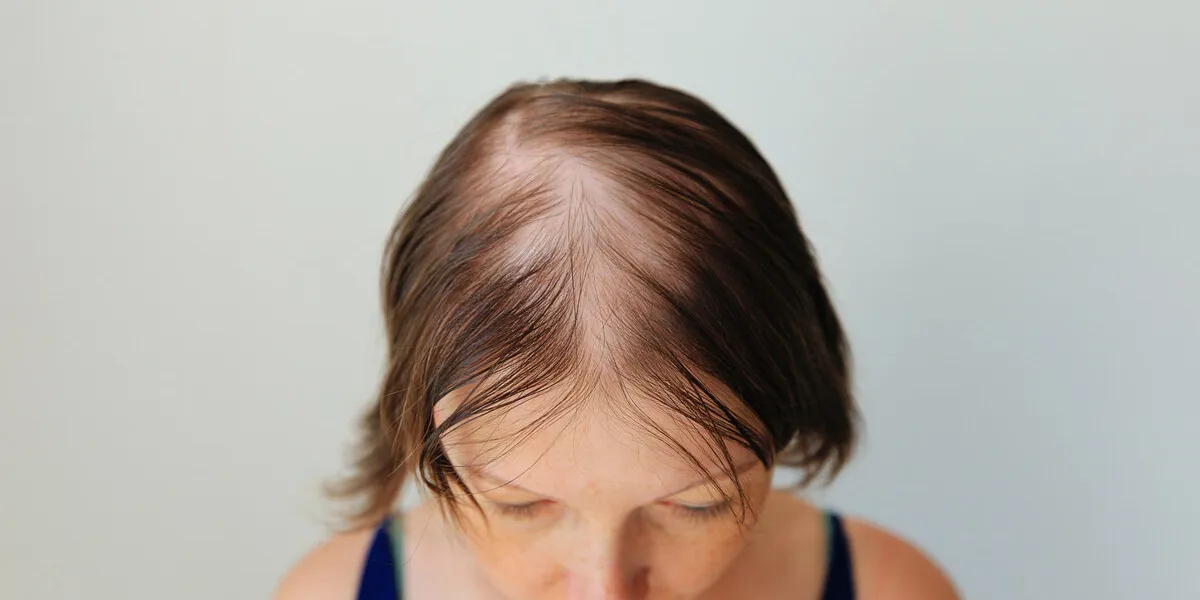 hair loss in the form of alopecia areata bald head of a woman hair thinning after covid bald patches of total alopecia