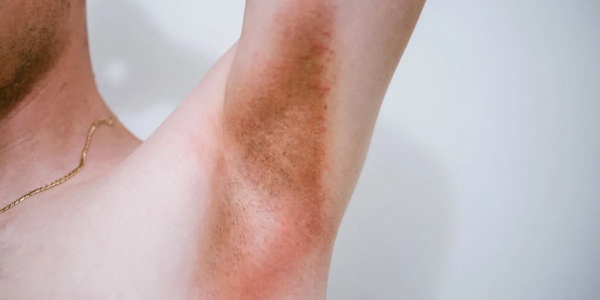 a man with a skin disease in the armpit area prickly heat