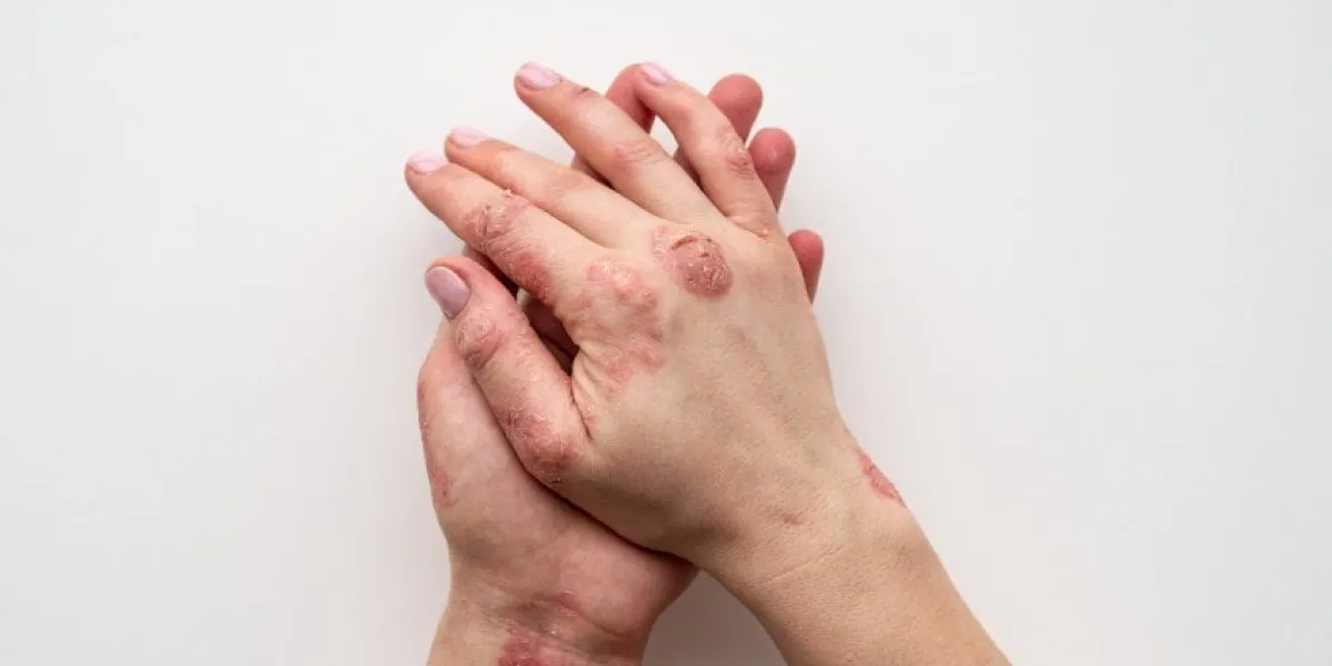 psoriasis skin closeup of rash and scaling on the patient's skin the concept of chronic disease treatment dermatological problems hard, horny and cracked skin in woman's hands dry skin isolated
