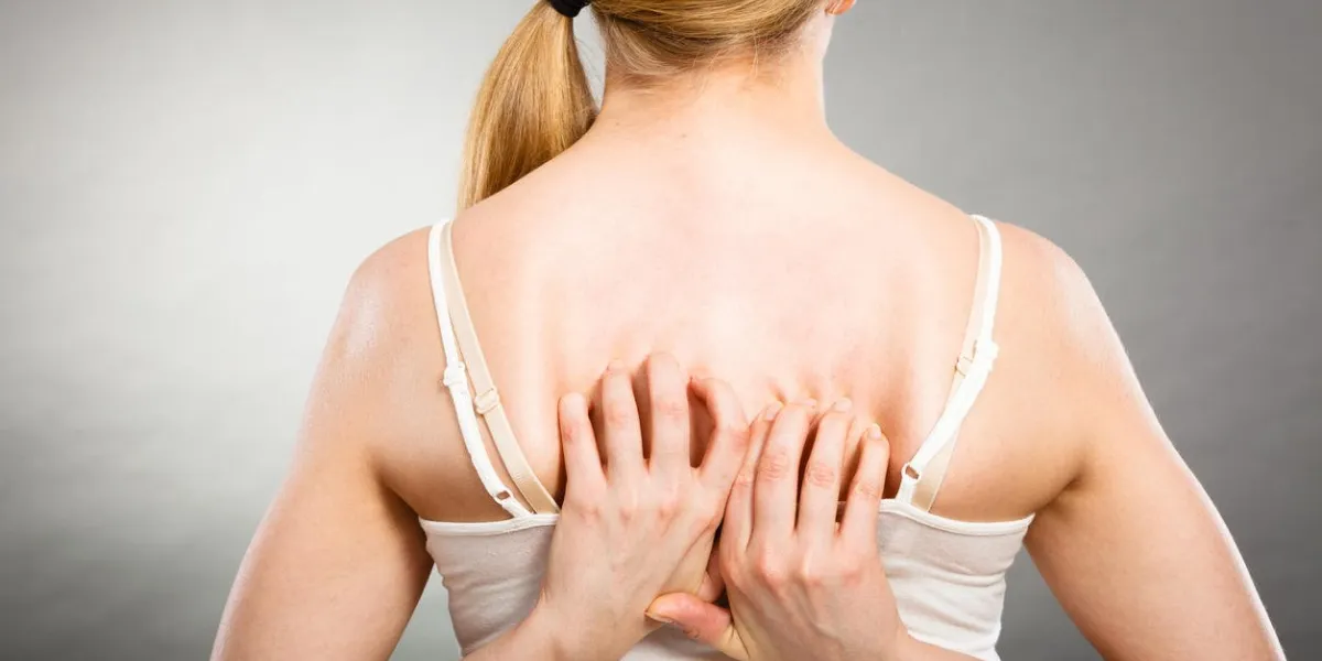 health problem, skin diseases young woman scratching her itchy back with allergy rash