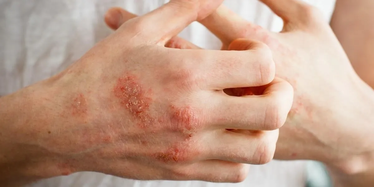 the problem with many people - eczema on hand white background man itchind skin