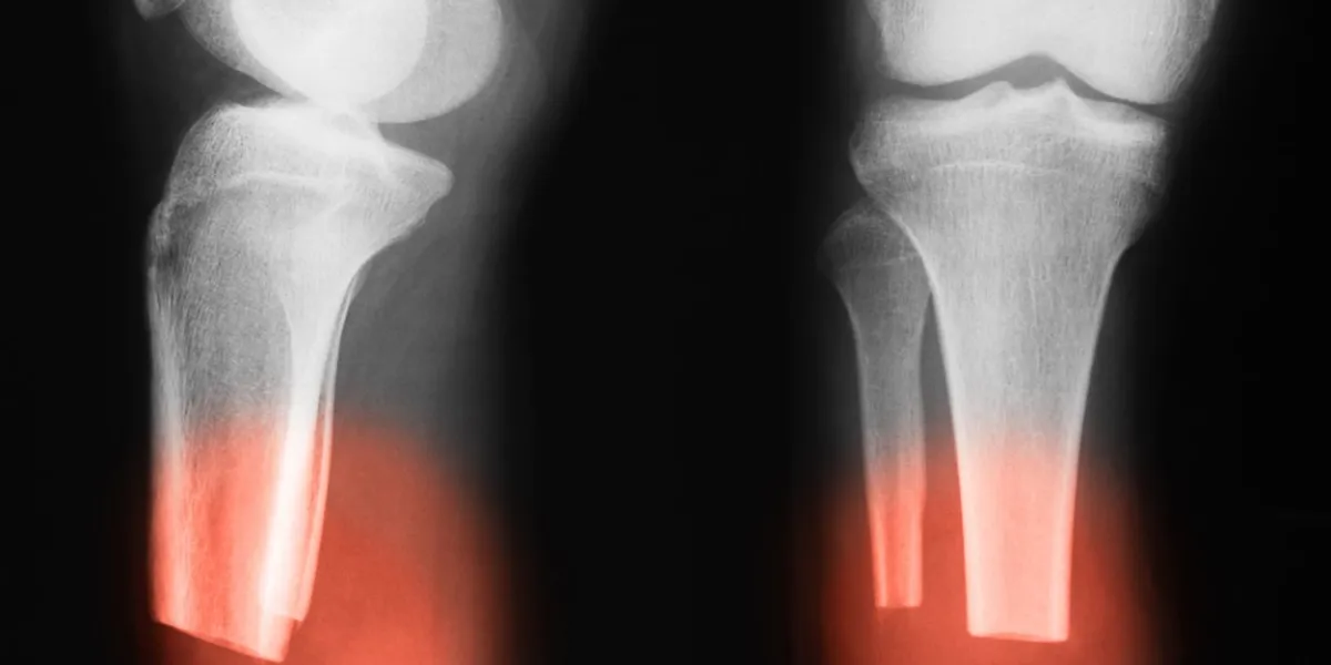 x-ray image of amputated lower leg, ap and lateral view