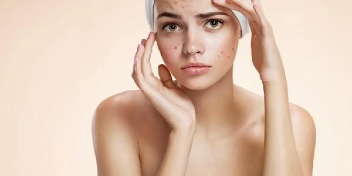 photos de fille laide problème de peau sur fond beige