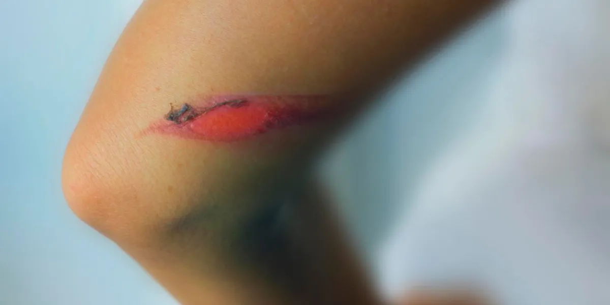 scarring burns effects - physical injury