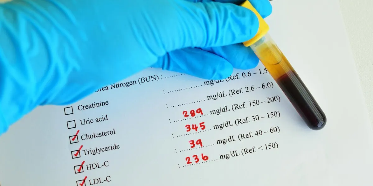 échantillon de sang avec un résultat élevé de profil lipidique