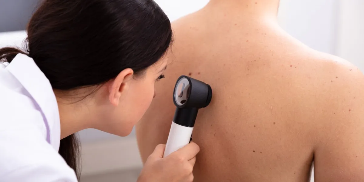 female doctor examining pigmented skin on man's back with dermatoscope