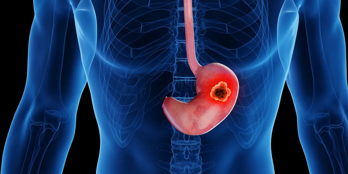 3d rendered medical illustration of stomach cancer plain black background professional studio lighting anterior view