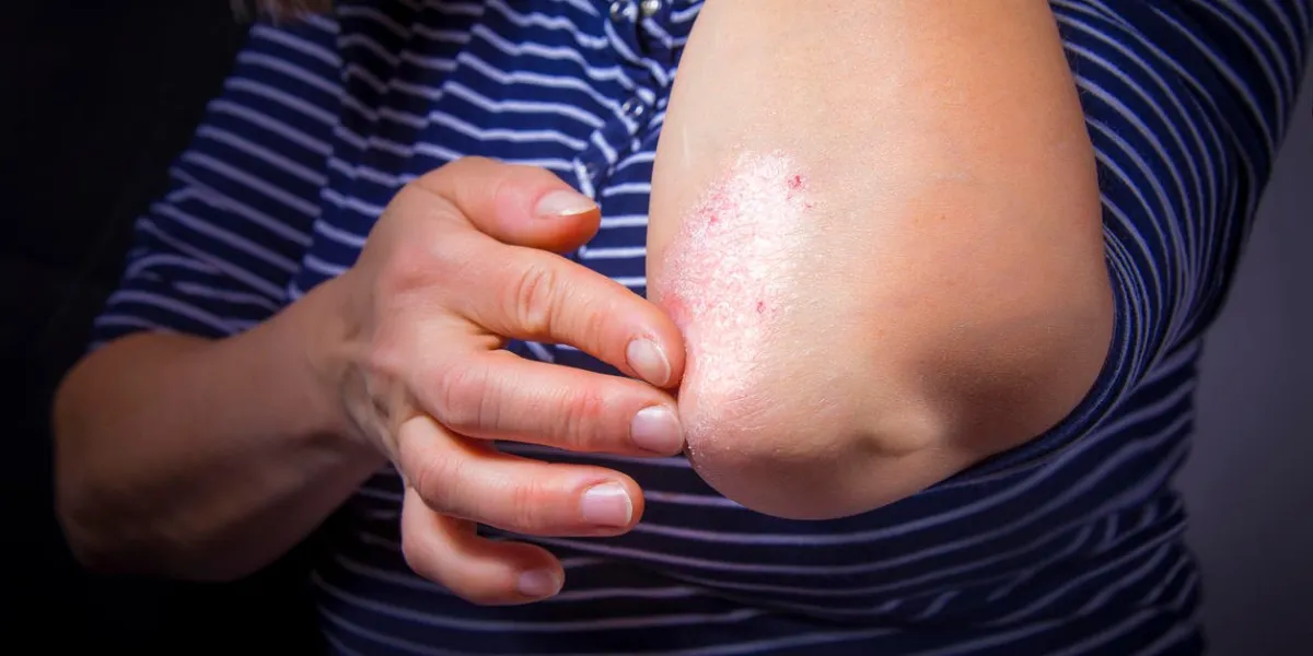 psoriasis sur fond noir de coudes