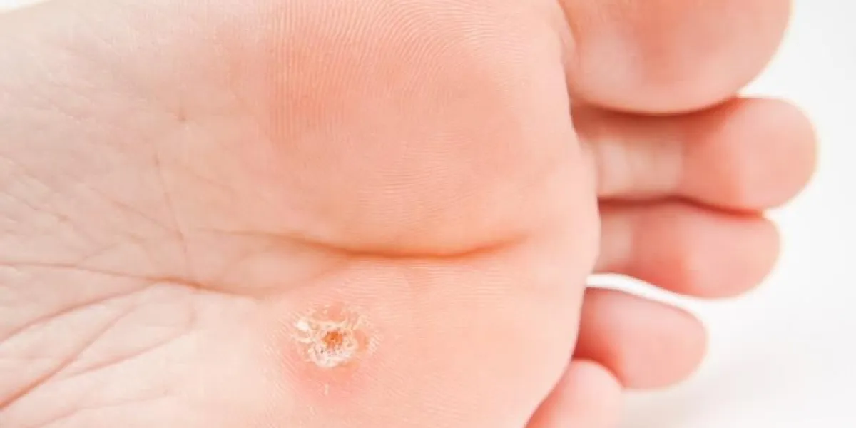 personne avec cals situé sous le pied, près des orteils vers le blanc