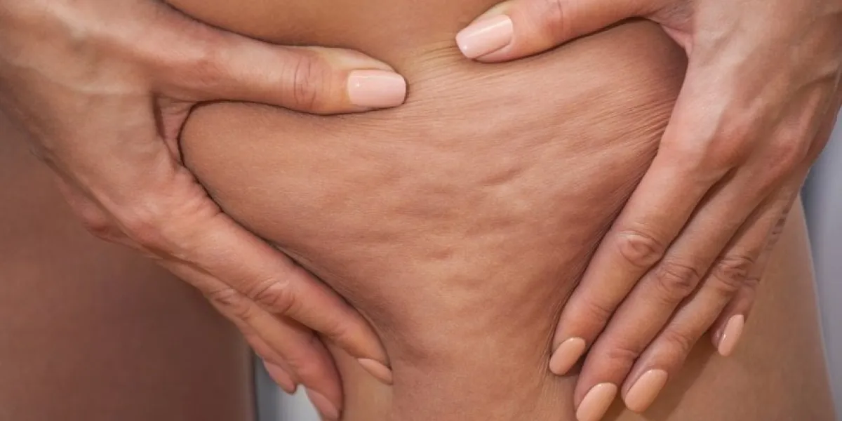 girl shows holding and pushing the skin of the legs cellulite, orange peel treatment and disposal of excess weight, the deposition of subcutaneous fat tissue