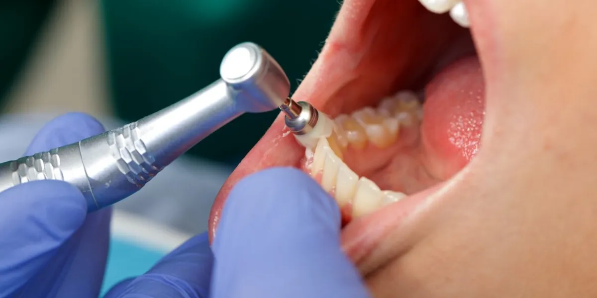 close up of a professional dental brushing at the clinic
