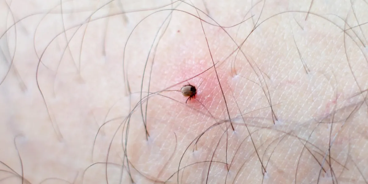 correct enlever une tique de la peau du patient