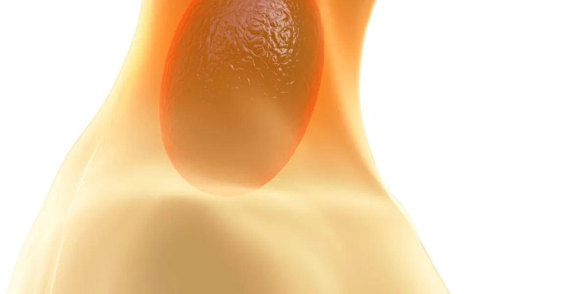 sore throat - 3d rendered illustration