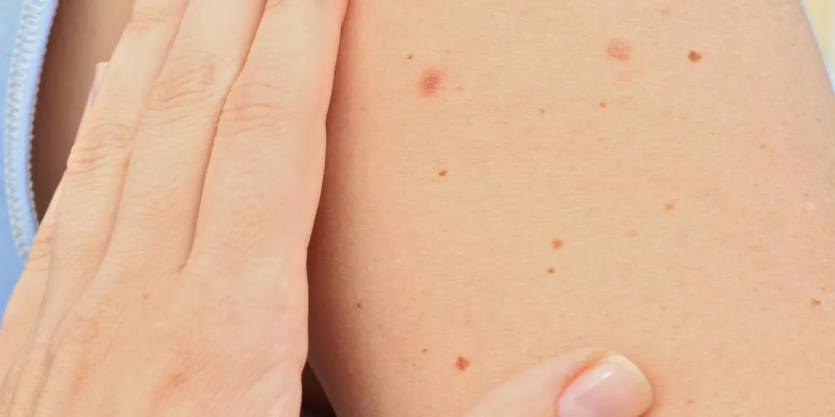 changements de taches de naissance contrôlant les taupes bénignes