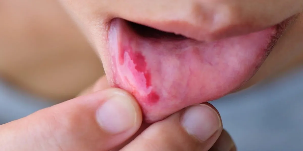 woman show her lower lip of the mouth with injury